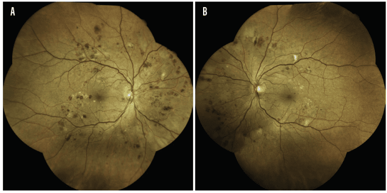 Imaging Techniques Demonstrate Consistency for Diagnosing Diabetic Retinopathy